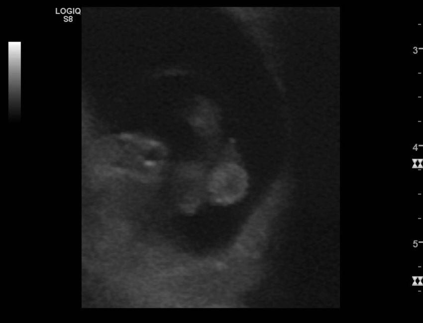 Normal early pregnancy - 8w0d (Radiopaedia 44715-48492 Longitudinal 45).jpg
