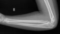 Normal elbow, radius and ulna x-ray - 6-year-old (Radiopaedia 53556-59584 Lateral 1).jpg