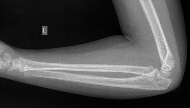File:Normal elbow, radius and ulna x-ray - 6-year-old (Radiopaedia 53556-59584 Lateral 1).jpg