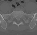 Normal lumbar spine CT (Radiopaedia 46533-50986 Axial bone window 69).png