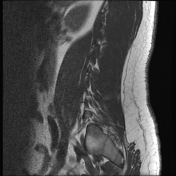 File:Normal lumbar spine MRI (Radiopaedia 43051-46311 Sagittal T1 19).jpg