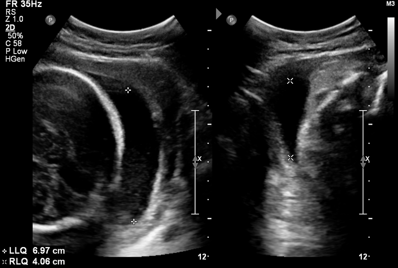 File:Normal third trimester amniotic fluid index and Doppler ultrasound (Radiopaedia 37831).png