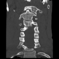 Normal trauma cervical spine (Radiopaedia 41017-43760 Coronal bone window 16).png