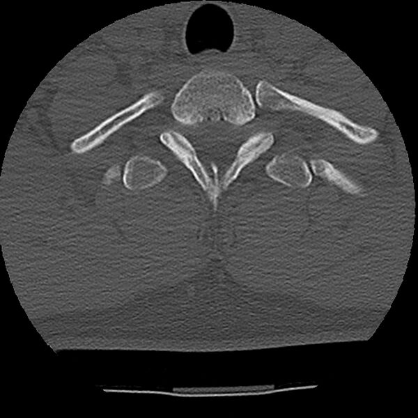 File:Normal trauma spine imaging (Radiopaedia 31753-32686 Axial bone window 76).jpg