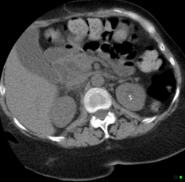 File:Obstructed infected horseshoe kidney (Radiopaedia 18116-17898 non-contrast 3).jpg