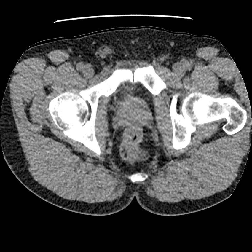 Obstructing ureteric calculus and ureteric anatomy (Radiopaedia 62730-71042 Axial non-contrast 169).jpg