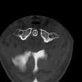 Occipital condyle fracture (Radiopaedia 31755-32691 Axial bone window 13).jpg