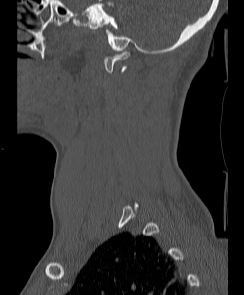 File:Occipital condyle fracture (Radiopaedia 61165-69056 Sagittal bone window 6).jpg