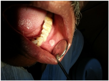 PMC3876769 CRIM.DENTISTRY2013-528967.001.png