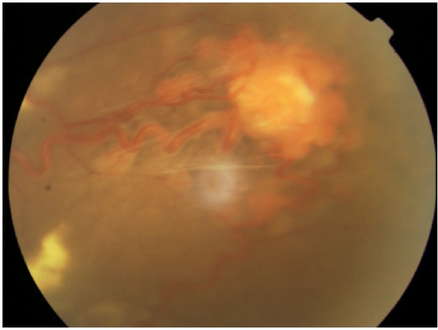 Fundus photograph of a retinal hemangioblastoma in a individual with Von Hippel-Lindau disease.