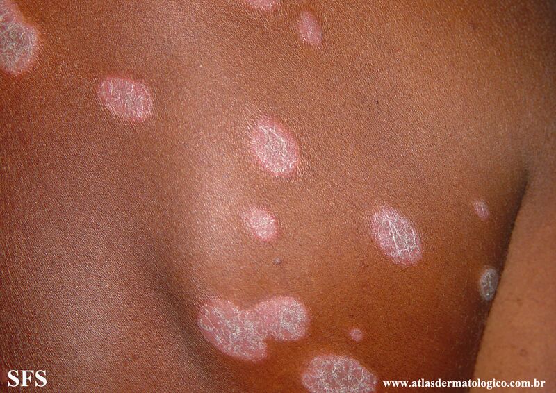 File:Psoriasis (Dermatology Atlas 112).jpg