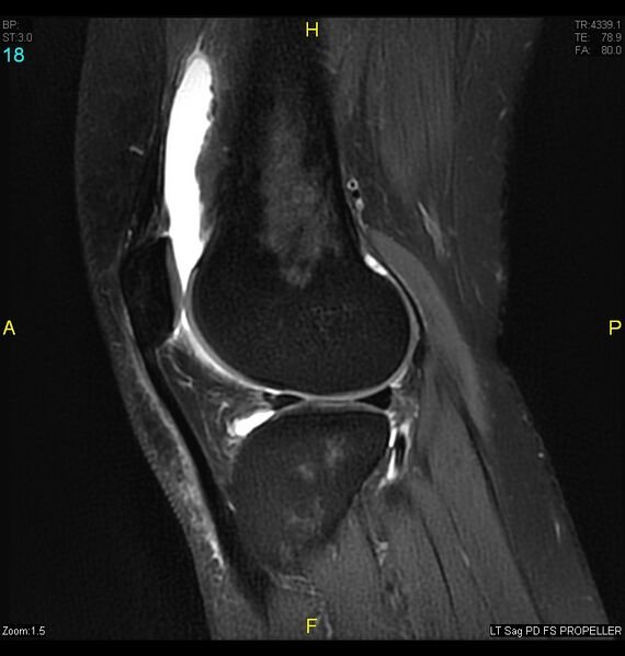 File:ACL mucoid degeration with cystic changes (Radiopaedia 48428-53341 Sagittal PD fat sat 16).jpg