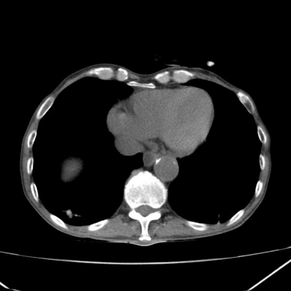 File:Abdominal aortic aneurysm (Radiopaedia 23703-23856 Axial non-contrast 2).jpg