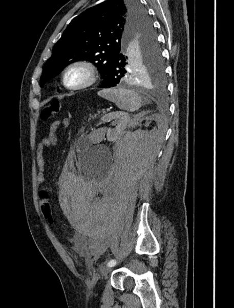 File:Abdominal aortic aneurysm rupture (Radiopaedia 54179-60362 Sagittal C+ arterial phase 32).jpg
