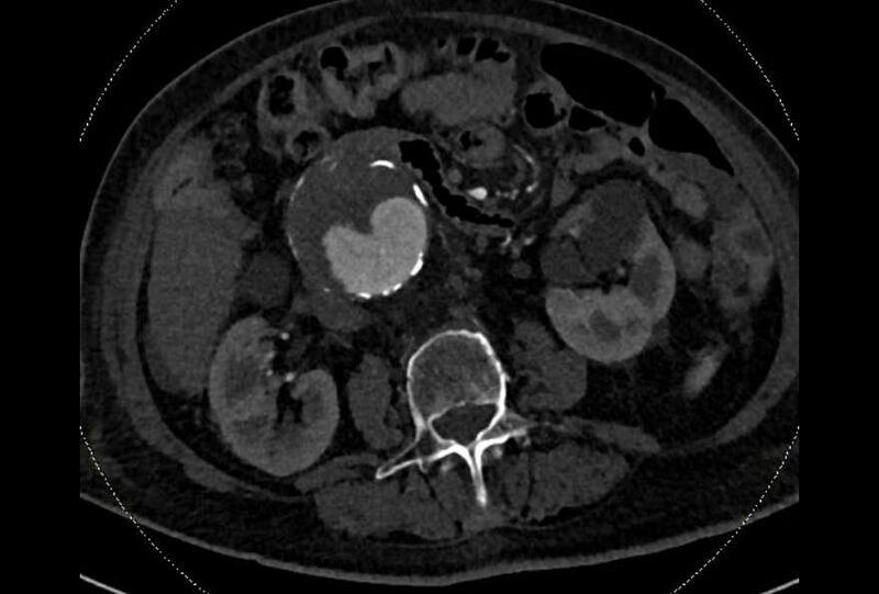 File:Abdominal aortic aneurysm with thrombus fissuration (Radiopaedia 73192-83919 Axial C+ arterial phase 85).jpg