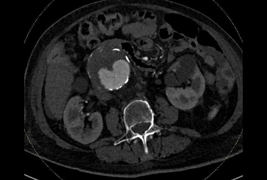 Abdominal aortic aneurysm with thrombus fissuration (Radiopaedia 73192-83919 Axial C+ arterial phase 85).jpg