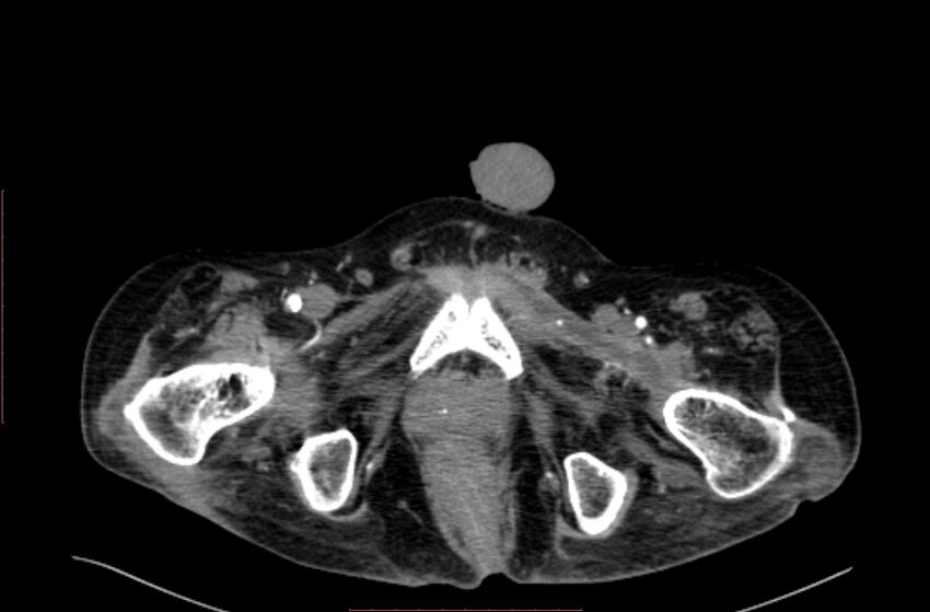 Abdominal aortic interposition tube graft and aneurysm thrombosis (Radiopaedia 71438-81857 Axial C+ arterial phase 255).jpg