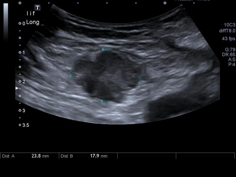 File:Abdominal wall metastasis from colorectal carcinoma (Radiopaedia 31016-31721 Transverse 11).jpg