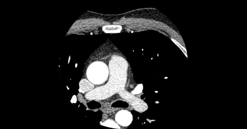 File:Aberrant left main coronary artery (ALMCA) arising from the right sinus with interarterial course (Radiopaedia 63251-71814 Axial C+ arterial phase 24).JPG