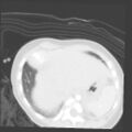 Aberrant left pulmonary artery (pulmonary sling) (Radiopaedia 42323-45435 Axial lung window 35).jpg