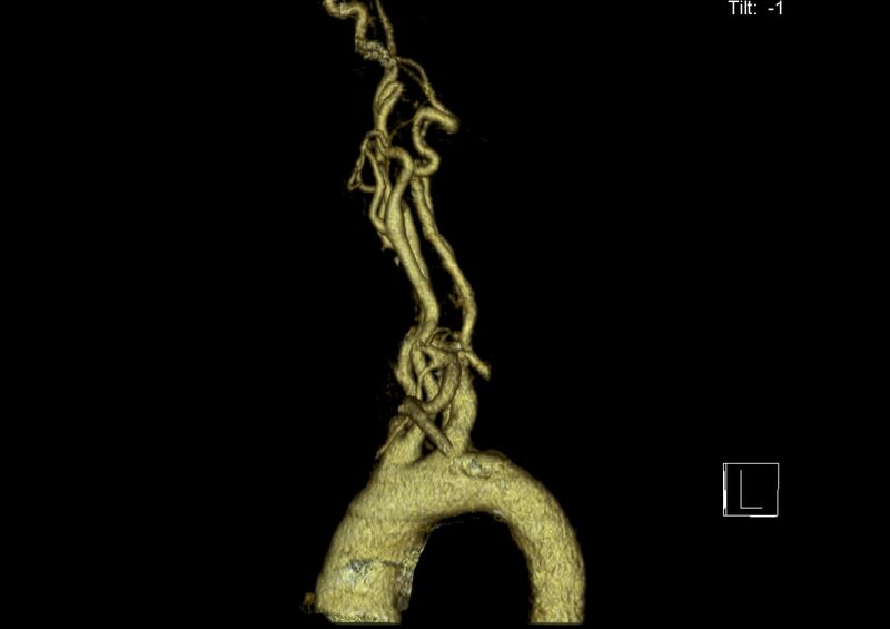 File:Aberrant right subclavian artery (Radiopaedia 19283-19294 3D reconstruction C+ arterial phase 14).jpg