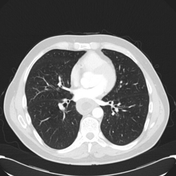 File:Achalasia (Radiopaedia 24937-25206 Axial lung window 20).jpg