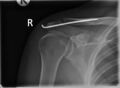 Acromioclavicular joint injury - Rockwood III (Radiopaedia 60196-67800 AP 1).jpg