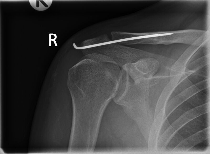 File:Acromioclavicular joint injury - Rockwood III (Radiopaedia 60196-67800 AP 1).jpg
