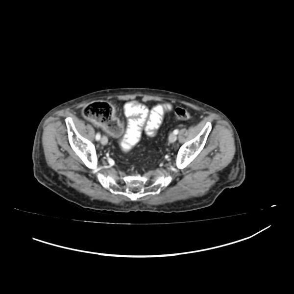 File:Acute-on-chronic Crohn disease with enteroenteric fistula (Radiopaedia 66686-75987 B 62).jpg