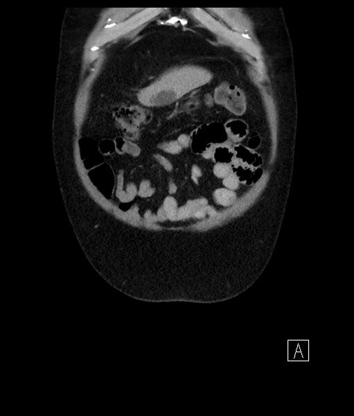 File:Acute-on-chronic pancreatitis (Radiopaedia 67286-76656 Coronal C+ portal venous phase 16).jpg