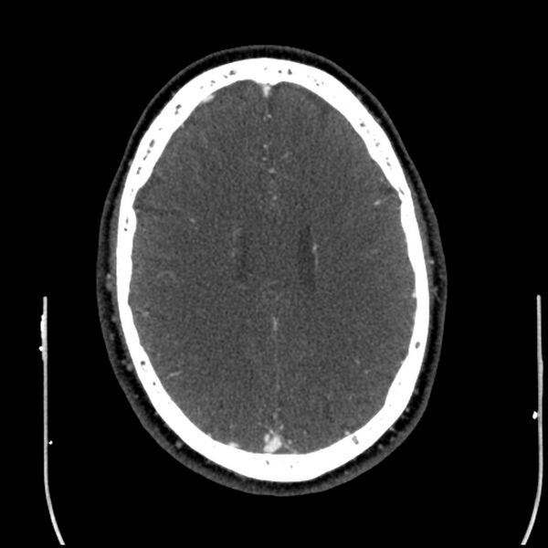 File:Acute A3 occlusion with ACA ischemic penumbra (CT perfusion) (Radiopaedia 72036-82527 Axial C+ arterial phase thins 26).jpg