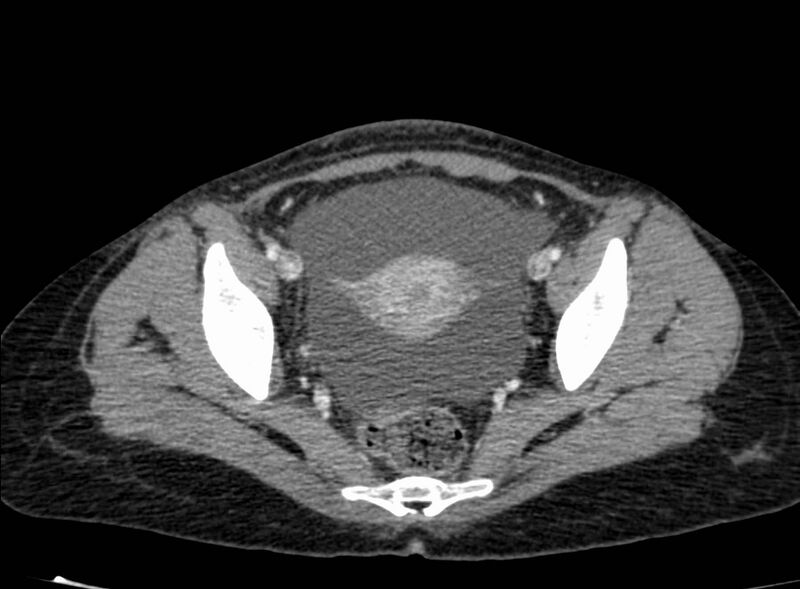 File:Acute Budd-Chiari syndrome (Radiopaedia 60858-68638 Axial C+ portal venous phase 262).jpg