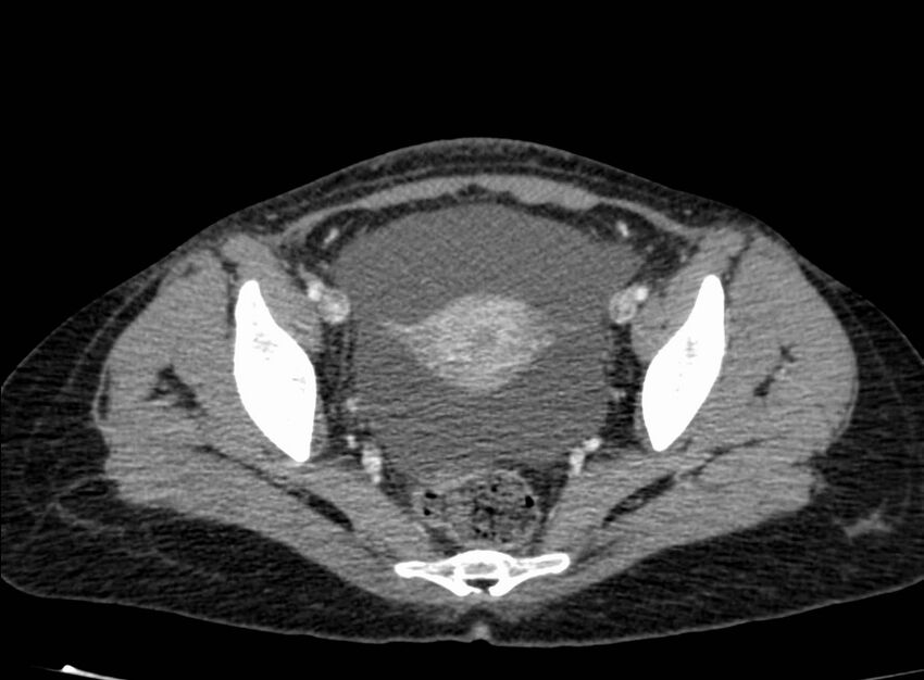 Acute Budd-Chiari syndrome (Radiopaedia 60858-68638 Axial C+ portal venous phase 262).jpg