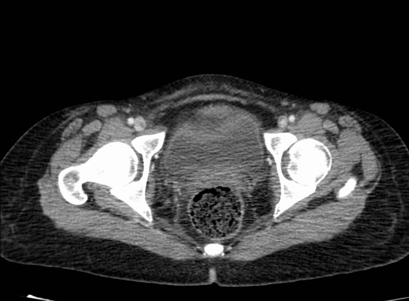 File:Acute Budd-Chiari syndrome (Radiopaedia 60858-68638 Axial C+ portal venous phase 286).jpg