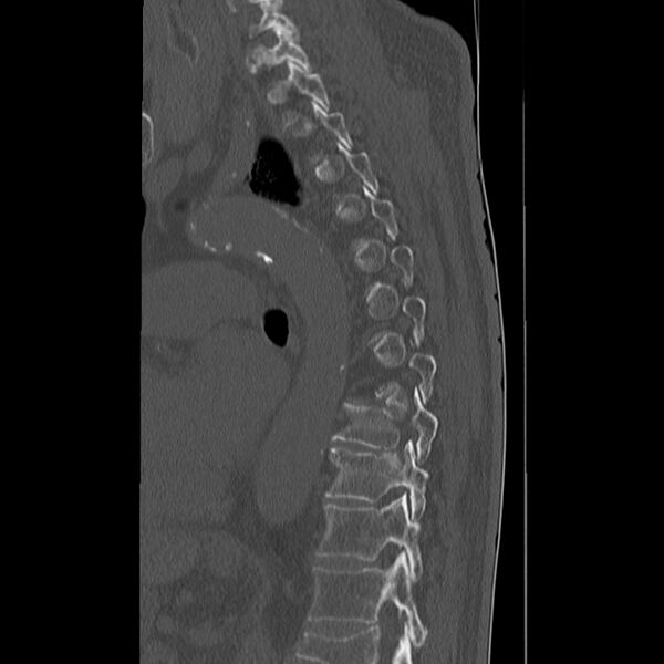 File:Acute and chronic vertebral compression fractures (Radiopaedia 31608-32494 Sagittal bone window 22).jpg