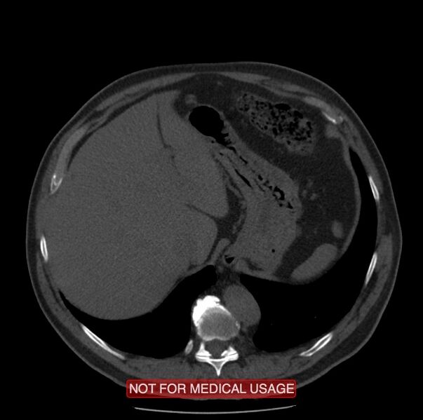 File:Acute aortic dissection - Stanford type A (Radiopaedia 40661-43285 Axial non-contrast 68).jpg