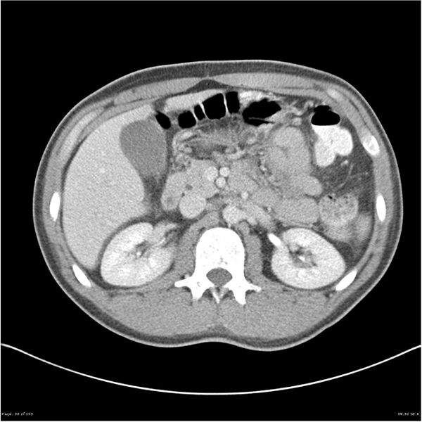 File:Acute appendicitis (Radiopaedia 25364-25615 B 20).jpg
