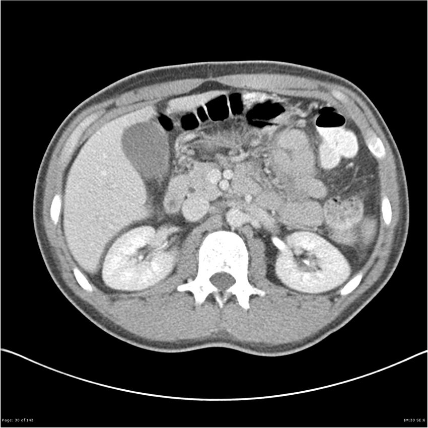 Acute appendicitis (Radiopaedia 25364-25615 B 20).jpg