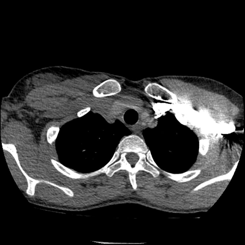 Acute chest syndrome - sickle cell disease (Radiopaedia 42375-45499 Axial C+ CTPA 30).jpg