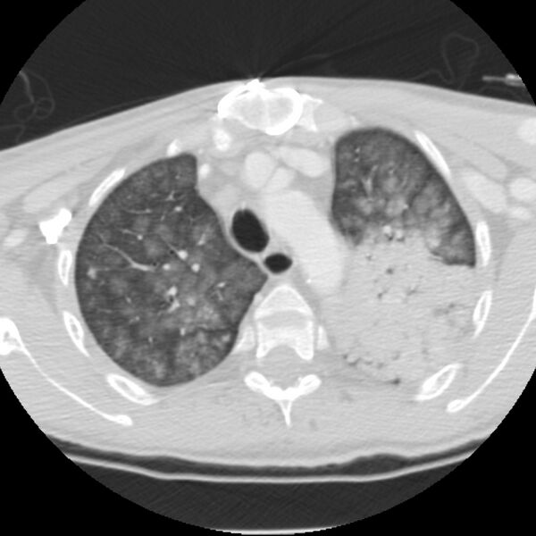 File:Acute diffuse alveolar hemorrhage (Radiopaedia 41323-44158 Axial lung window 12).jpg