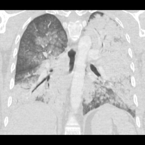 File:Acute diffuse alveolar hemorrhage (Radiopaedia 41323-44158 Coronal lung window 35).jpg
