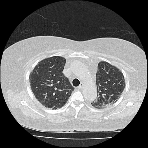 File:Acute interstitial pneumonitis (Radiopaedia 45404-49452 Axial lung window 29).jpg