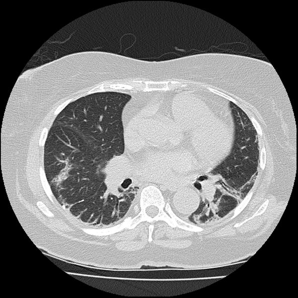 File:Acute interstitial pneumonitis (Radiopaedia 45404-49452 Axial lung window 51).jpg