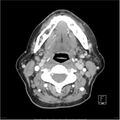 Acute left parotid sialadenitis (Radiopaedia 26160-26295 C+ arterial phase 26).jpg