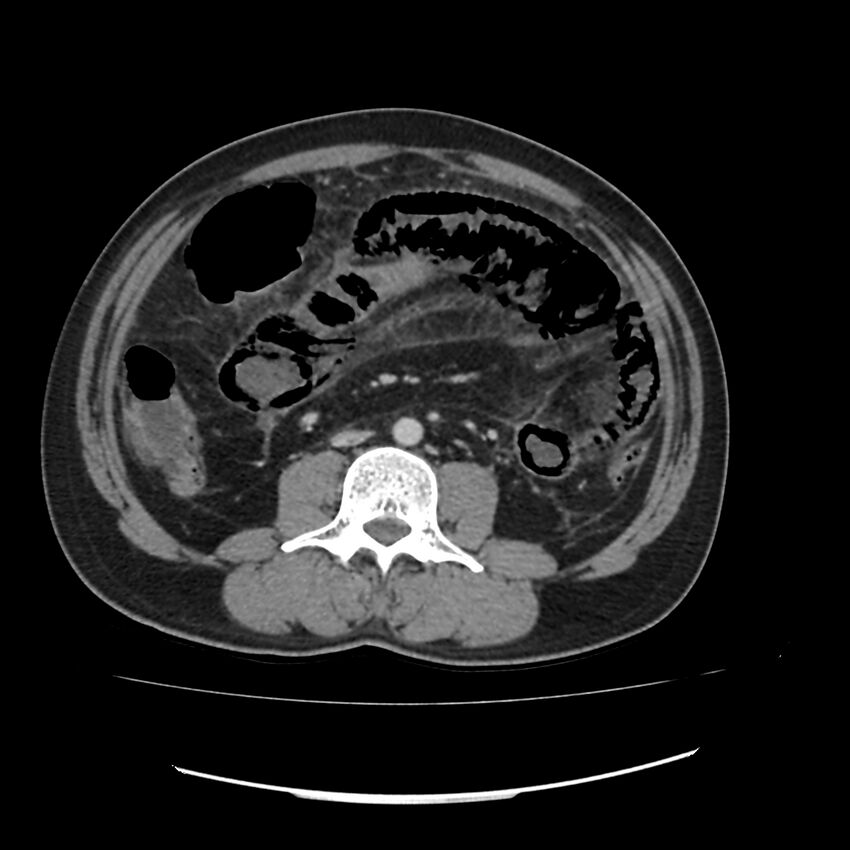 Acute mesenteric ischemia - superior mesenteric artery thrombosis (Radiopaedia 73947-84776 Axial C+ portal venous phase 78).jpg