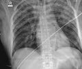 Acute myocardial infarction in CT (Radiopaedia 39947-42416 Frontal 1).jpg