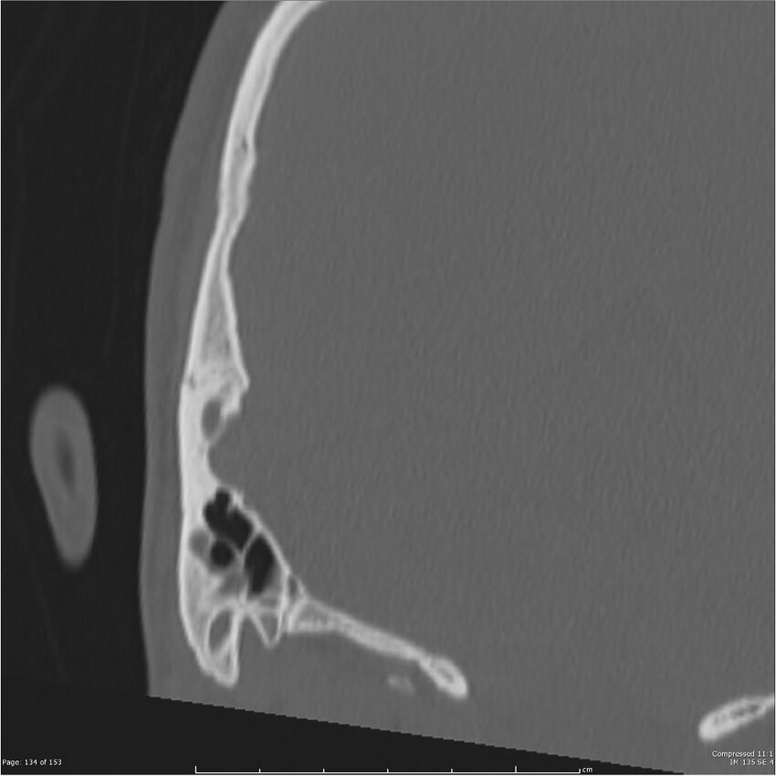 Acute otomastoiditis (Radiopaedia 28276-28512 Coronal PTB bone window reformat 65).jpg