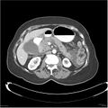 Acute pancreatitis (Radiopaedia 19136-19117 Axial C+ portal venous phase 16).jpg