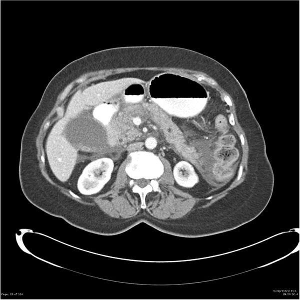 File:Acute pancreatitis (Radiopaedia 19136-19117 Axial C+ portal venous phase 16).jpg