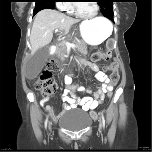 File:Acute pancreatitis (Radiopaedia 19136-19117 Coronal C+ portal venous phase 14).jpg